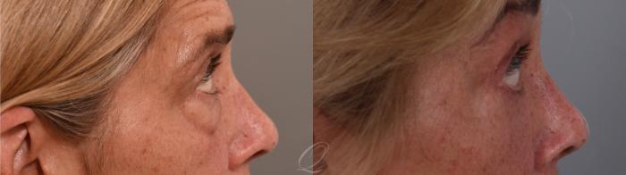 Eyelid Lift Case 1002002 Before & After Left Side | Serving Rochester, Syracuse & Buffalo, NY | Quatela Center for Plastic Surgery