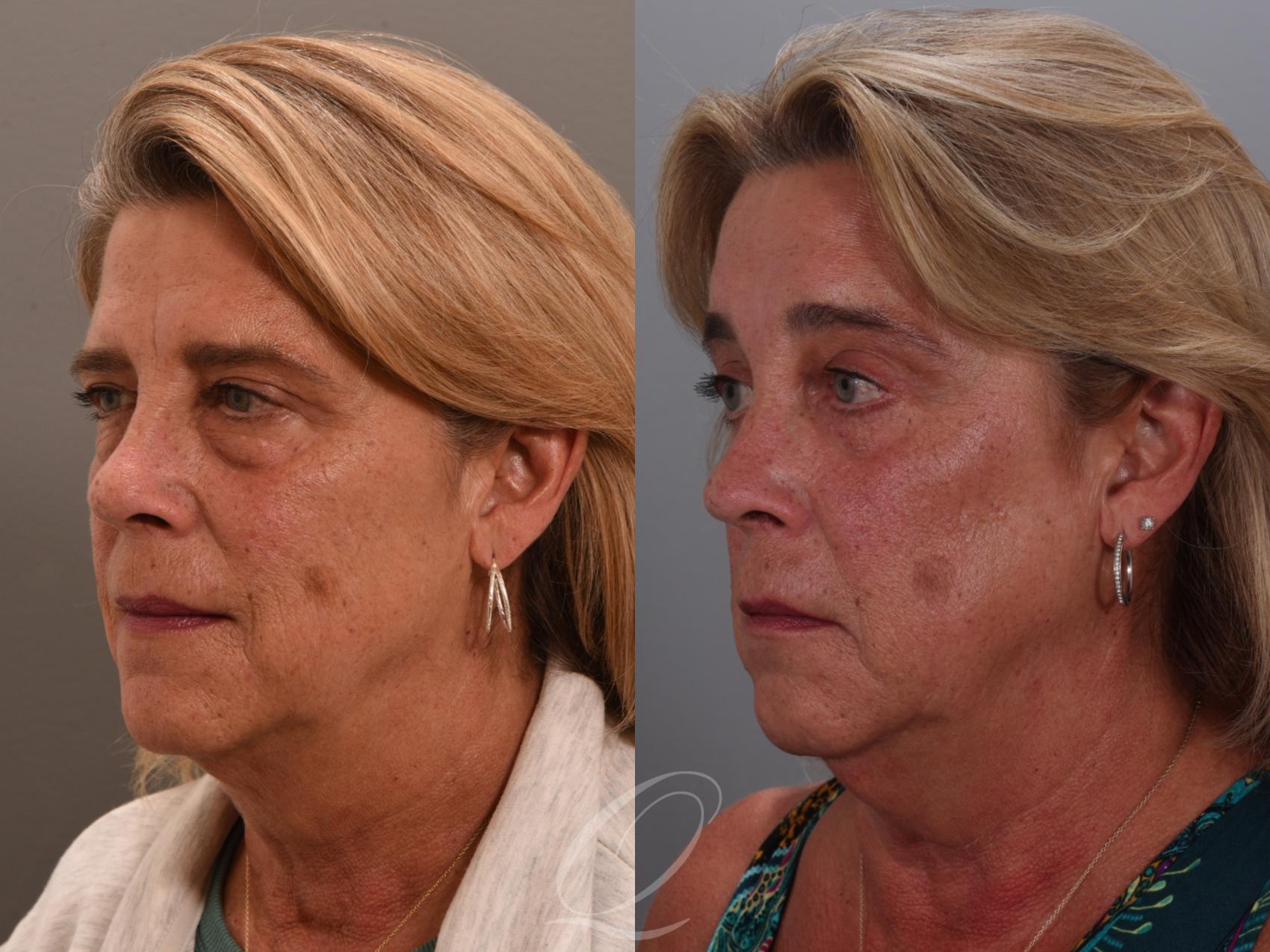 Eyelid Lift Case 1002002 Before & After Right Oblique | Serving Rochester, Syracuse & Buffalo, NY | Quatela Center for Plastic Surgery
