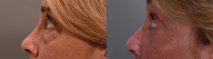 Eyelid Lift Case 1002002 Before & After Right Side | Serving Rochester, Syracuse & Buffalo, NY | Quatela Center for Plastic Surgery