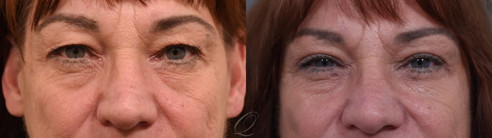 Eyelid Lift Case 1002004 Before & After Back | Serving Rochester, Syracuse & Buffalo, NY | Quatela Center for Plastic Surgery