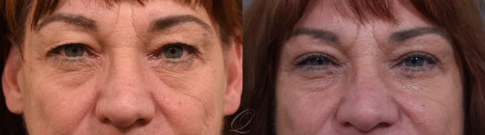 Eyelid Lift Case 1002004 Before & After Back | Serving Rochester, Syracuse & Buffalo, NY | Quatela Center for Plastic Surgery