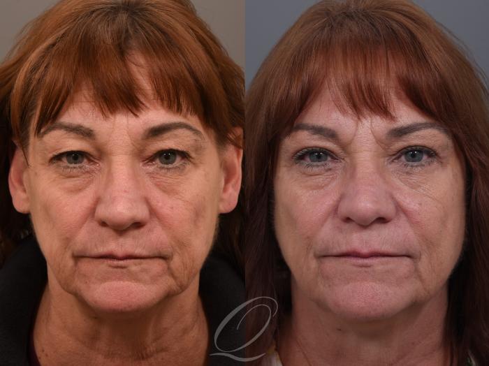 Eyelid Lift Case 1002004 Before & After Front | Serving Rochester, Syracuse & Buffalo, NY | Quatela Center for Plastic Surgery