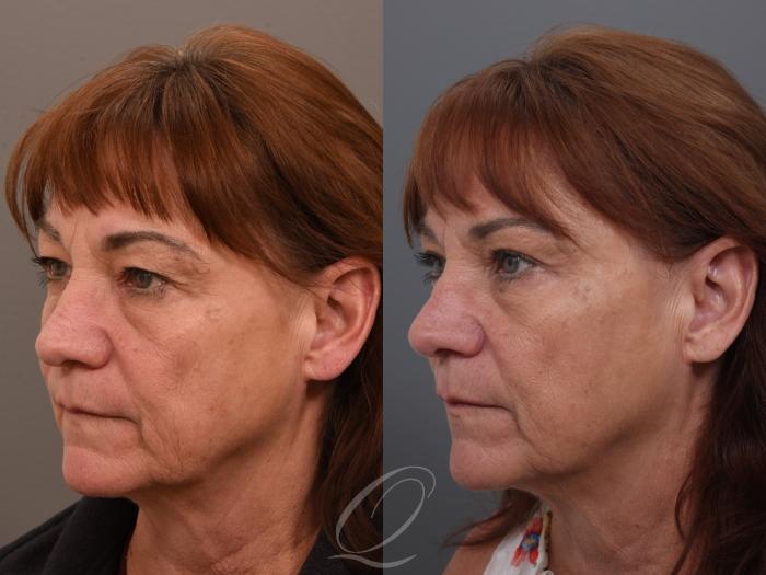 Eyelid Lift Case 1002004 Before & After Left Oblique | Serving Rochester, Syracuse & Buffalo, NY | Quatela Center for Plastic Surgery