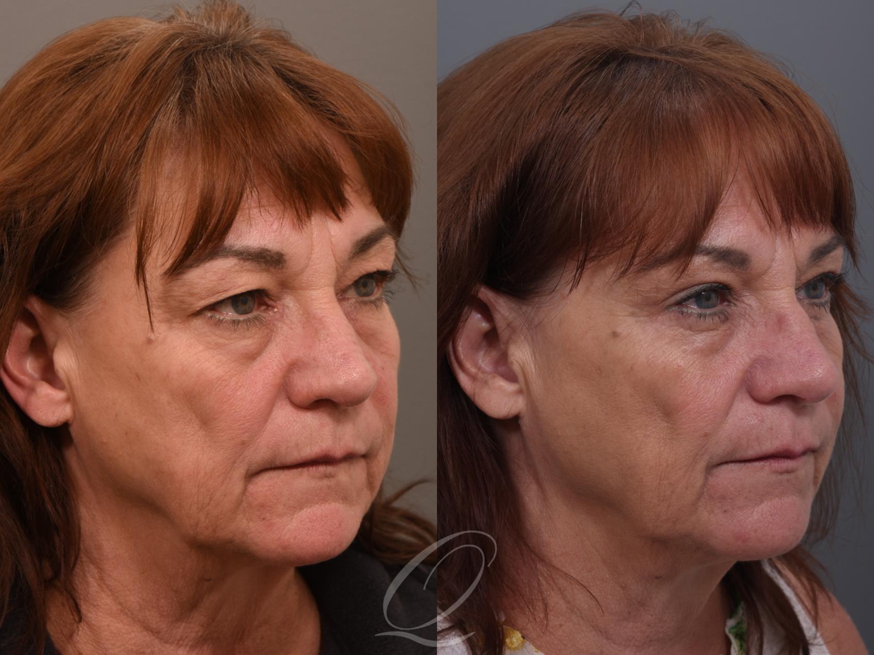 Eyelid Lift Case 1002004 Before & After Right Oblique | Serving Rochester, Syracuse & Buffalo, NY | Quatela Center for Plastic Surgery