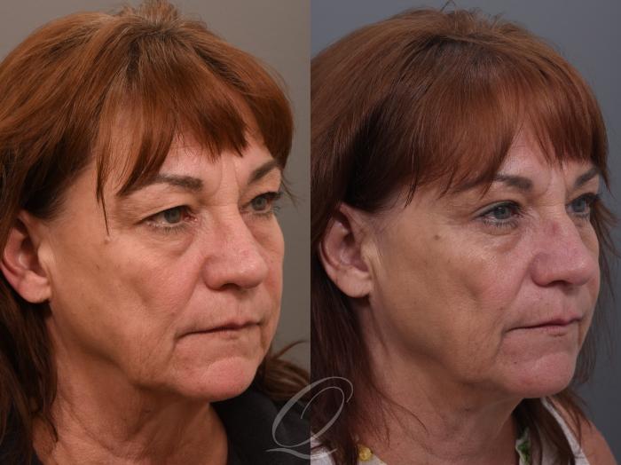 Eyelid Lift Case 1002004 Before & After Right Oblique | Serving Rochester, Syracuse & Buffalo, NY | Quatela Center for Plastic Surgery