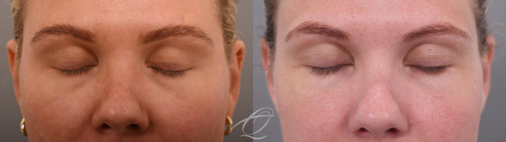 Eyelid Lift Case 1002065 Before & After Eyes closed | Serving Rochester, Syracuse & Buffalo, NY | Quatela Center for Plastic Surgery
