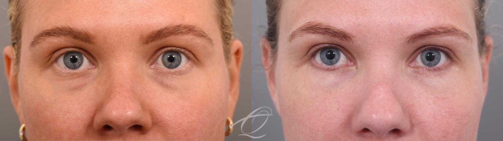 Eyelid Lift Case 1002065 Before & After Front | Serving Rochester, Syracuse & Buffalo, NY | Quatela Center for Plastic Surgery