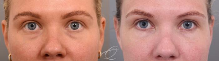 Eyelid Lift Case 1002065 Before & After Front | Serving Rochester, Syracuse & Buffalo, NY | Quatela Center for Plastic Surgery
