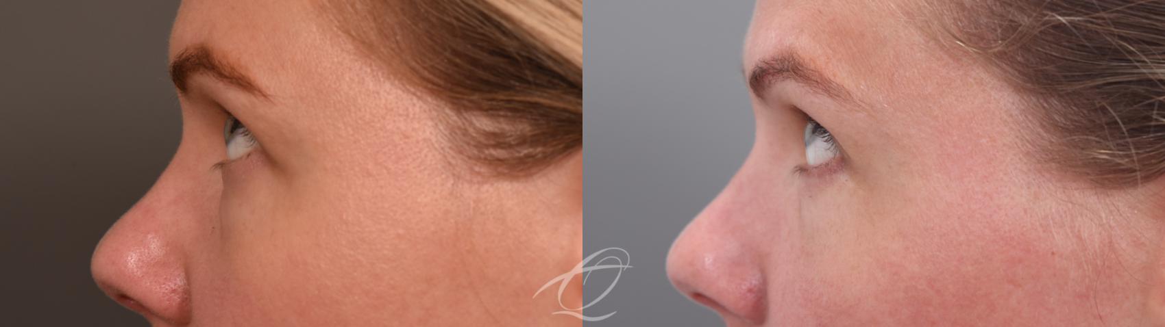 Eyelid Lift Case 1002065 Before & After Left Side 2 | Serving Rochester, Syracuse & Buffalo, NY | Quatela Center for Plastic Surgery
