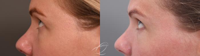 Eyelid Lift Case 1002065 Before & After Left Side 2 | Serving Rochester, Syracuse & Buffalo, NY | Quatela Center for Plastic Surgery