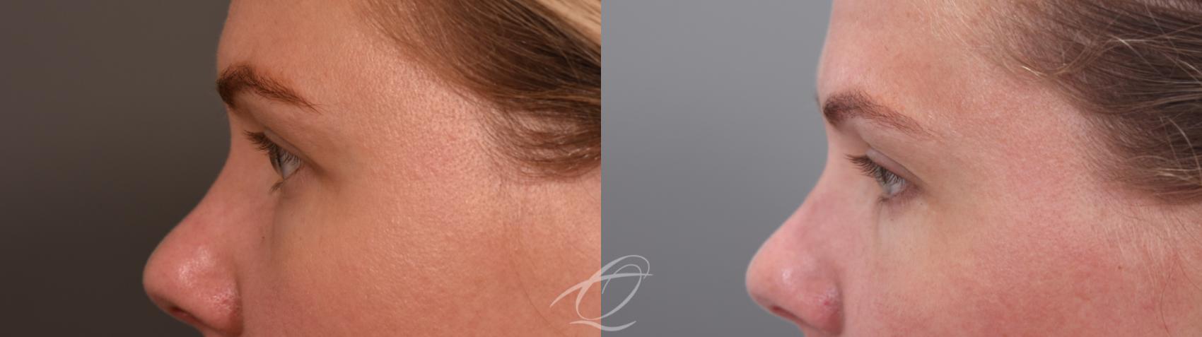 Eyelid Lift Case 1002065 Before & After Left Side | Serving Rochester, Syracuse & Buffalo, NY | Quatela Center for Plastic Surgery