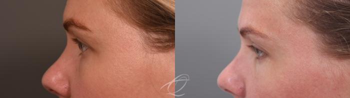 Eyelid Lift Case 1002065 Before & After Left Side | Serving Rochester, Syracuse & Buffalo, NY | Quatela Center for Plastic Surgery