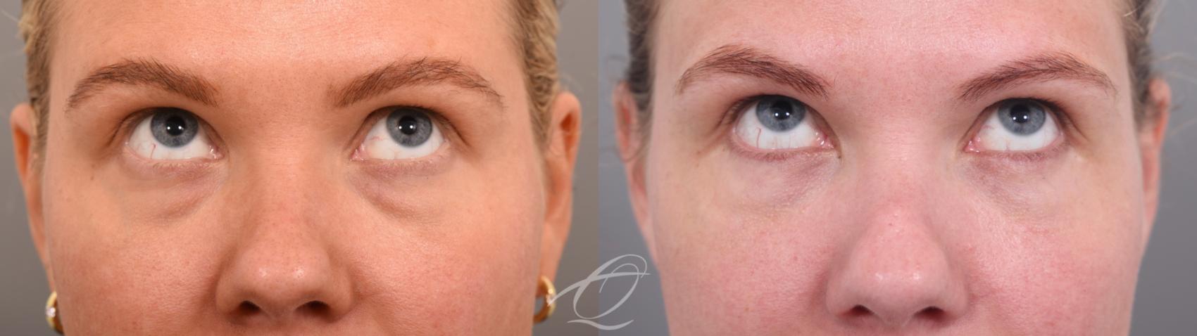 Eyelid Lift Case 1002065 Before & After Looking up | Serving Rochester, Syracuse & Buffalo, NY | Quatela Center for Plastic Surgery