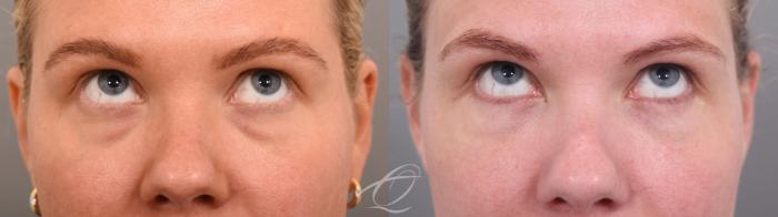 Eyelid Lift Case 1002065 Before & After Looking up | Serving Rochester, Syracuse & Buffalo, NY | Quatela Center for Plastic Surgery