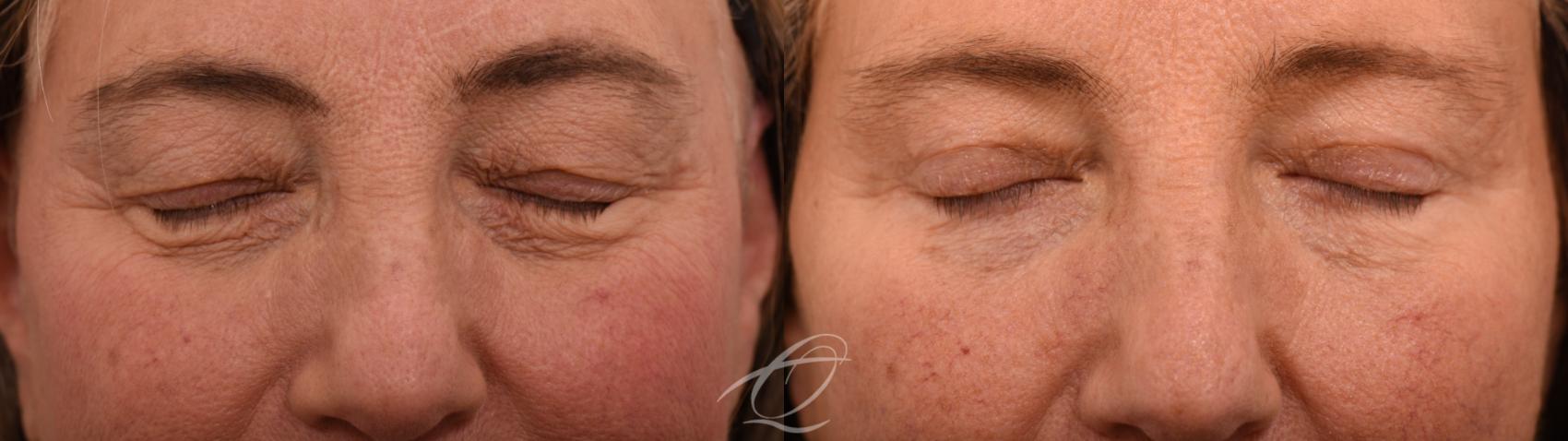 Eyelid Lift Case 1002066 Before & After Eyes closed | Serving Rochester, Syracuse & Buffalo, NY | Quatela Center for Plastic Surgery