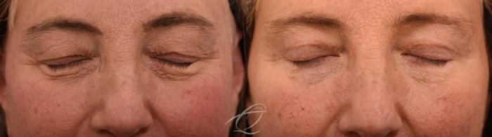 Eyelid Lift Case 1002066 Before & After Eyes closed | Serving Rochester, Syracuse & Buffalo, NY | Quatela Center for Plastic Surgery