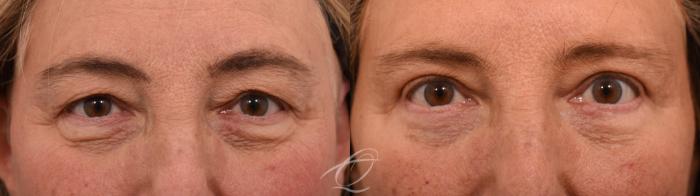 Eyelid Lift Case 1002066 Before & After Front | Serving Rochester, Syracuse & Buffalo, NY | Quatela Center for Plastic Surgery