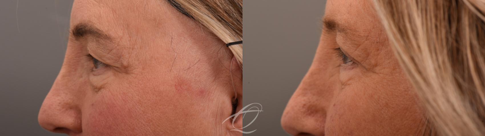 Eyelid Lift Case 1002066 Before & After Left Side | Serving Rochester, Syracuse & Buffalo, NY | Quatela Center for Plastic Surgery