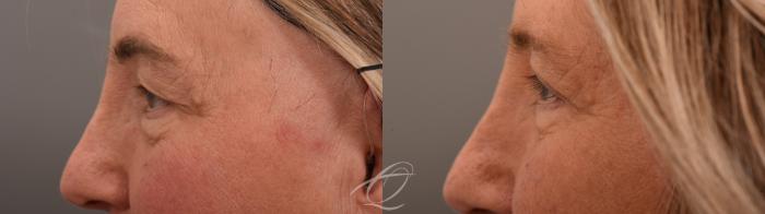 Eyelid Lift Case 1002066 Before & After Left Side | Serving Rochester, Syracuse & Buffalo, NY | Quatela Center for Plastic Surgery