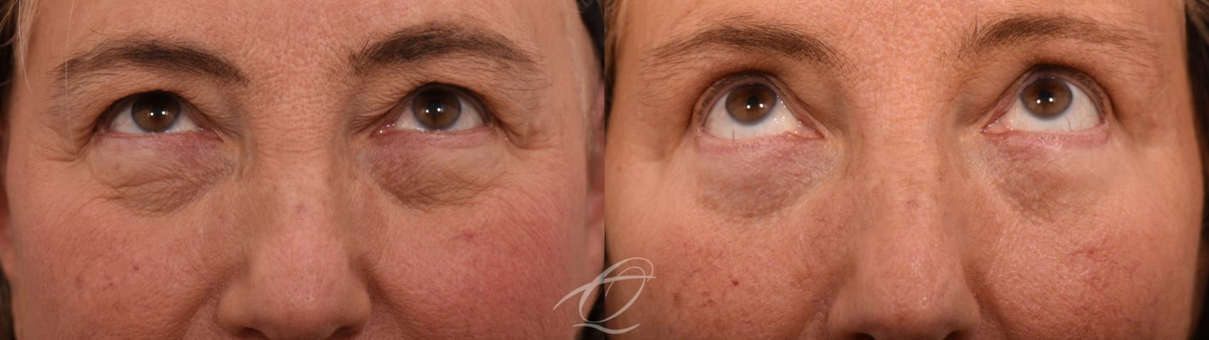 Eyelid Lift Case 1002066 Before & After Looking up | Serving Rochester, Syracuse & Buffalo, NY | Quatela Center for Plastic Surgery