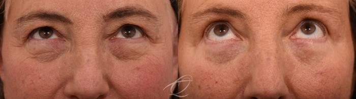 Eyelid Lift Case 1002066 Before & After Looking up | Serving Rochester, Syracuse & Buffalo, NY | Quatela Center for Plastic Surgery