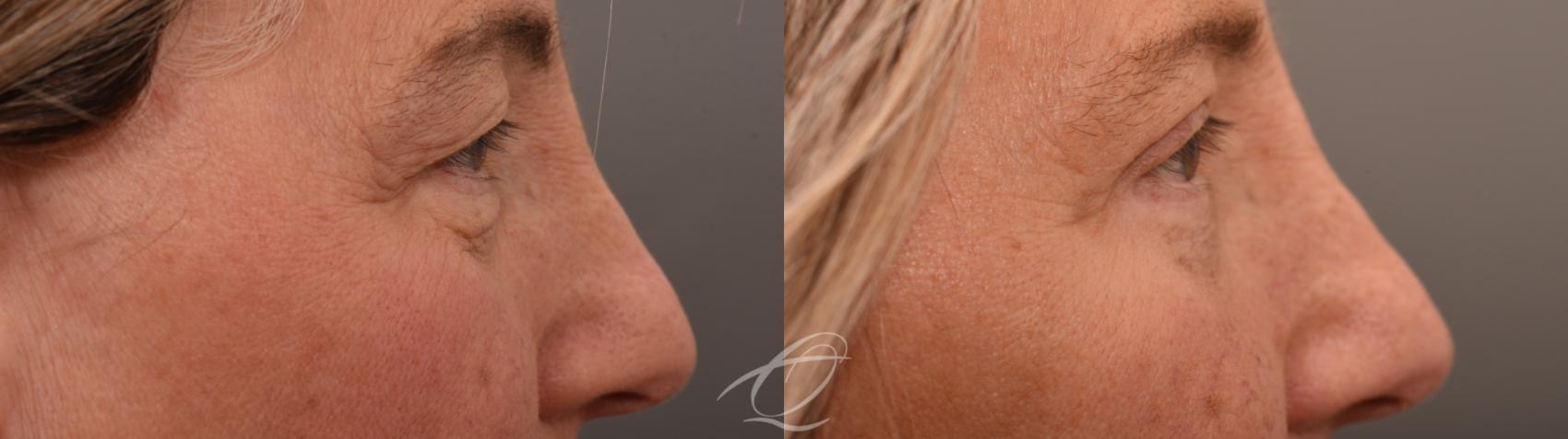 Eyelid Lift Case 1002066 Before & After Right Side | Serving Rochester, Syracuse & Buffalo, NY | Quatela Center for Plastic Surgery