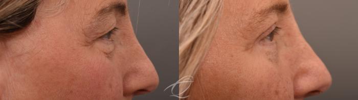 Eyelid Lift Case 1002066 Before & After Right Side | Serving Rochester, Syracuse & Buffalo, NY | Quatela Center for Plastic Surgery