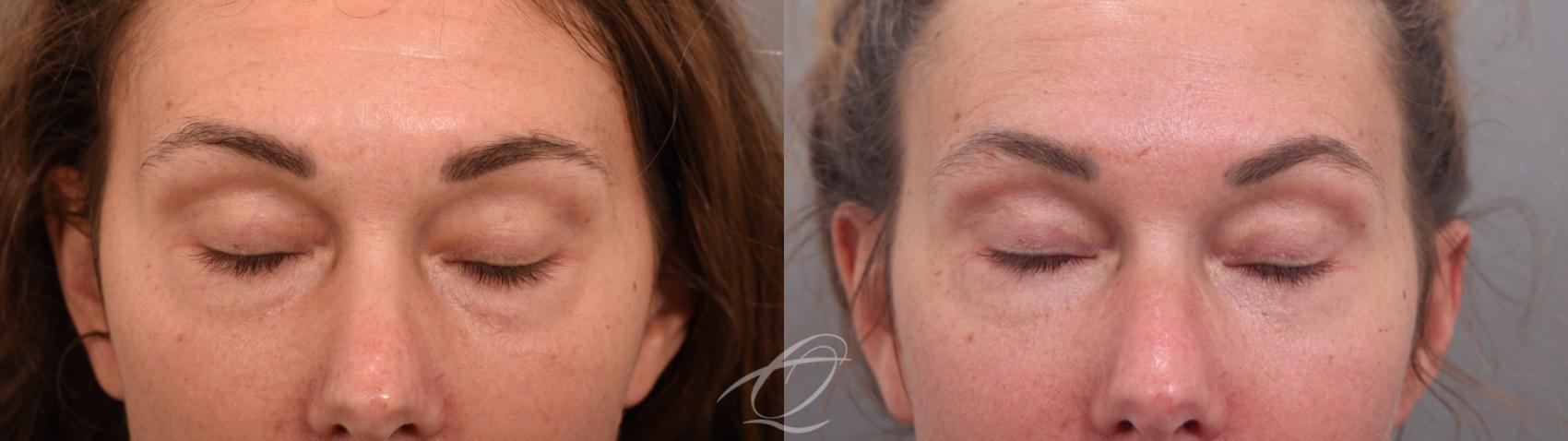 Eyelid Lift Case 1002067 Before & After Eyes closed | Serving Rochester, Syracuse & Buffalo, NY | Quatela Center for Plastic Surgery