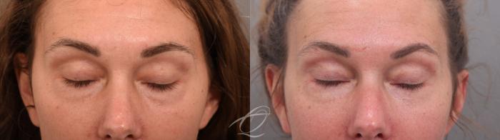 Eyelid Lift Case 1002067 Before & After Eyes closed | Serving Rochester, Syracuse & Buffalo, NY | Quatela Center for Plastic Surgery