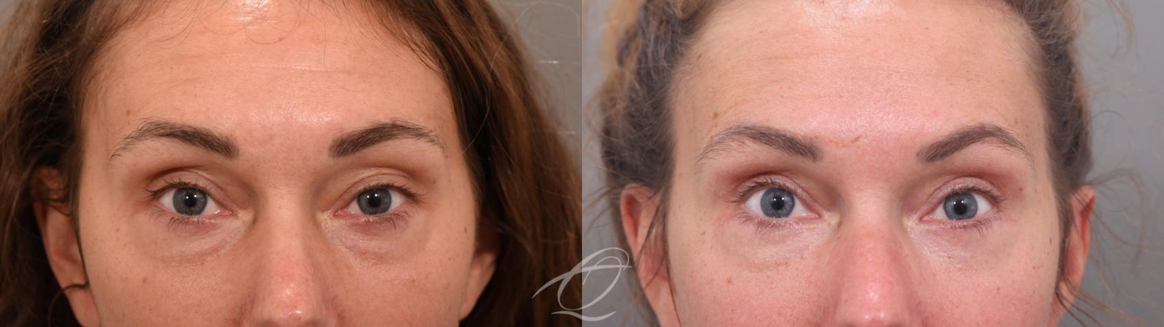 Eyelid Lift Case 1002067 Before & After Front | Serving Rochester, Syracuse & Buffalo, NY | Quatela Center for Plastic Surgery