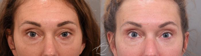 Eyelid Lift Case 1002067 Before & After Front | Serving Rochester, Syracuse & Buffalo, NY | Quatela Center for Plastic Surgery