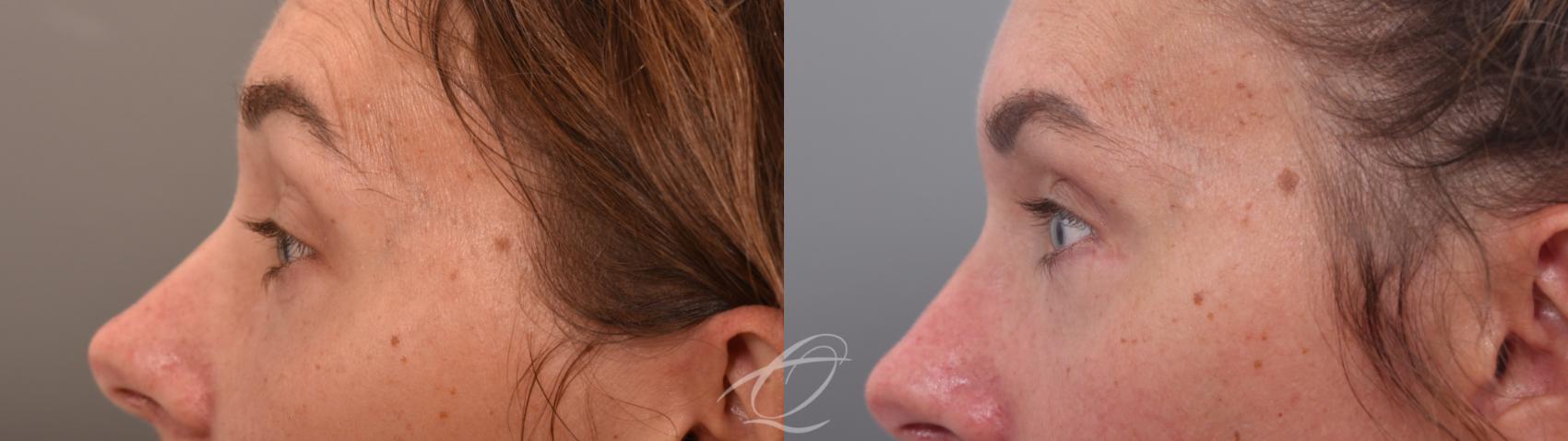 Eyelid Lift Case 1002067 Before & After Left Side | Serving Rochester, Syracuse & Buffalo, NY | Quatela Center for Plastic Surgery