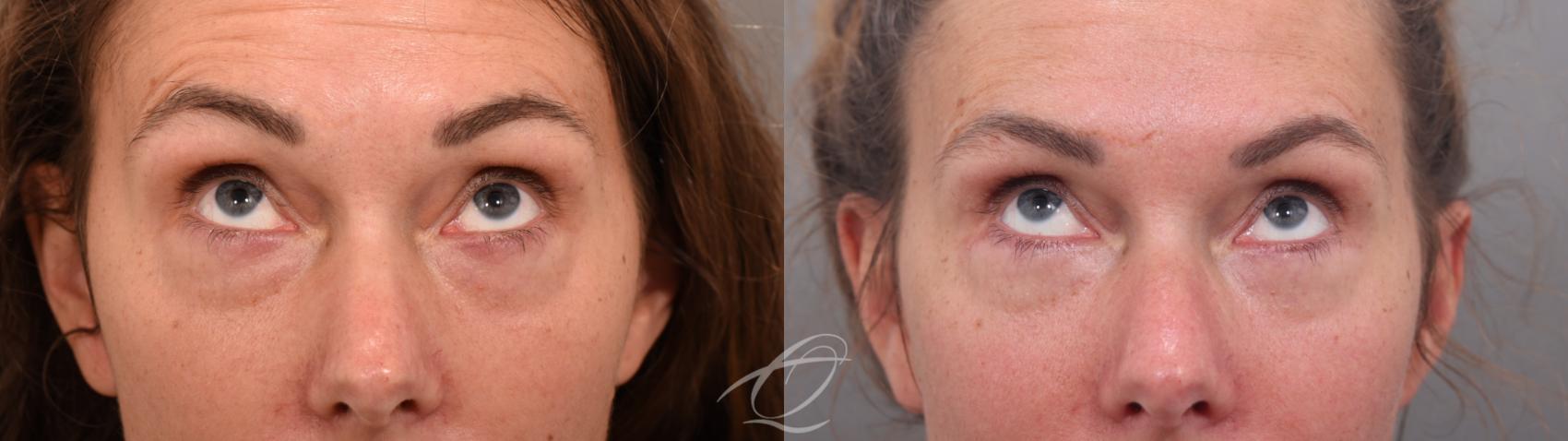 Eyelid Lift Case 1002067 Before & After Looking up | Serving Rochester, Syracuse & Buffalo, NY | Quatela Center for Plastic Surgery