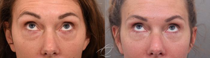 Eyelid Lift Case 1002067 Before & After Looking up | Serving Rochester, Syracuse & Buffalo, NY | Quatela Center for Plastic Surgery