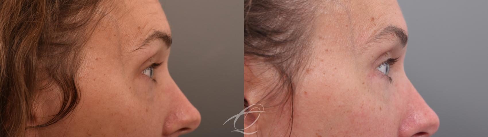 Eyelid Lift Case 1002067 Before & After Right Side | Serving Rochester, Syracuse & Buffalo, NY | Quatela Center for Plastic Surgery