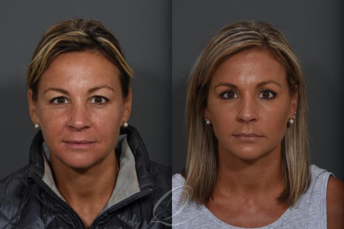 Eyelid Lift Case 1361 Before & After Front | Serving Rochester, Syracuse & Buffalo, NY | Quatela Center for Plastic Surgery