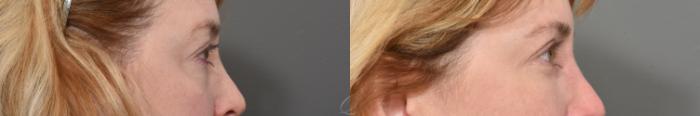Eyelid Lift Case 1366 Before & After Right Side | Serving Rochester, Syracuse & Buffalo, NY | Quatela Center for Plastic Surgery