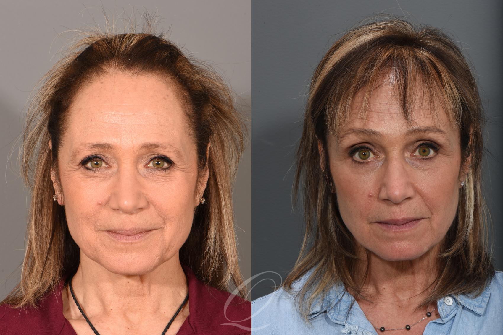 Eyelid Lift Case 1367 Before & After Front | Serving Rochester, Syracuse & Buffalo, NY | Quatela Center for Plastic Surgery