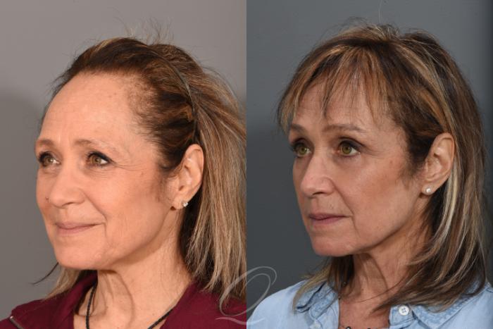 Eyelid Lift Case 1367 Before & After Left Oblique | Serving Rochester, Syracuse & Buffalo, NY | Quatela Center for Plastic Surgery