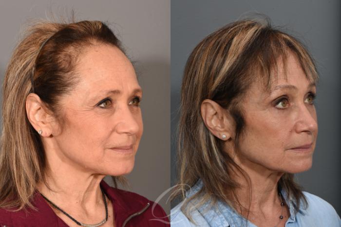 Eyelid Lift Case 1367 Before & After Right Oblique | Serving Rochester, Syracuse & Buffalo, NY | Quatela Center for Plastic Surgery