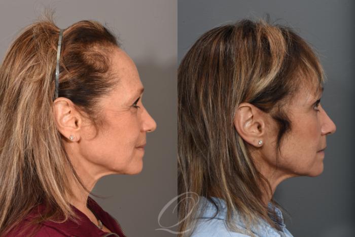 Eyelid Lift Case 1367 Before & After Right Side | Serving Rochester, Syracuse & Buffalo, NY | Quatela Center for Plastic Surgery