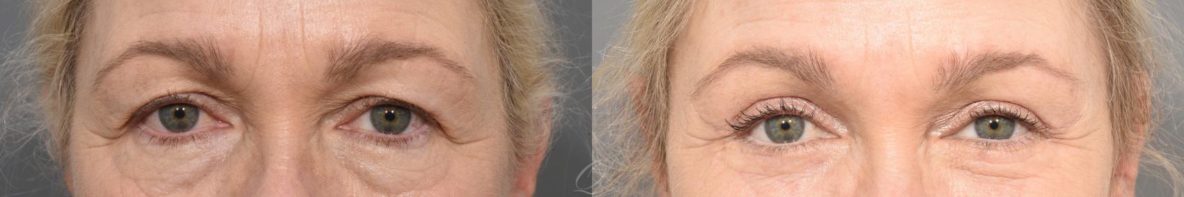 Eyelid Lift Case 1368 Before & After Front | Serving Rochester, Syracuse & Buffalo, NY | Quatela Center for Plastic Surgery