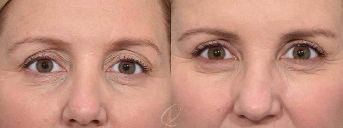 Eyelid Lift Case 1370 Before & After Front | Serving Rochester, Syracuse & Buffalo, NY | Quatela Center for Plastic Surgery