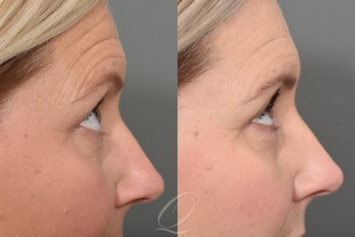 Eyelid Lift Case 1370 Before & After Right Side | Serving Rochester, Syracuse & Buffalo, NY | Quatela Center for Plastic Surgery