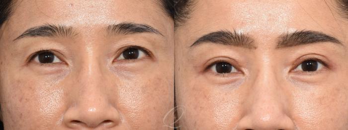 Eyelid Lift Case 1401 Before & After Front | Serving Rochester, Syracuse & Buffalo, NY | Quatela Center for Plastic Surgery