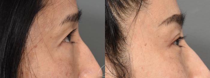 Eyelid Lift Case 1401 Before & After Right Side | Serving Rochester, Syracuse & Buffalo, NY | Quatela Center for Plastic Surgery