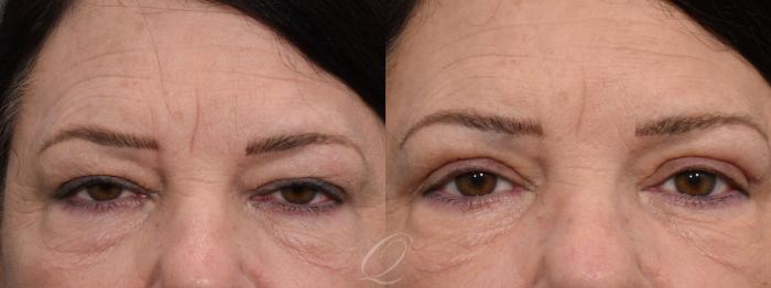 Eyelid Lift Case 1402 Before & After Front | Serving Rochester, Syracuse & Buffalo, NY | Quatela Center for Plastic Surgery