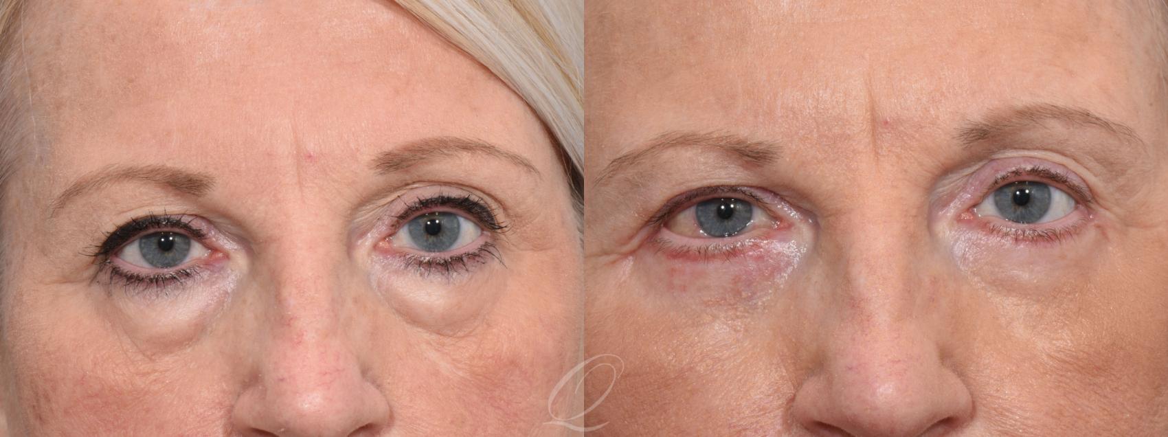 Eyelid Lift Case 1403 Before & After Front | Serving Rochester, Syracuse & Buffalo, NY | Quatela Center for Plastic Surgery