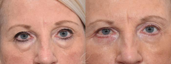 Eyelid Lift Case 1403 Before & After Front | Serving Rochester, Syracuse & Buffalo, NY | Quatela Center for Plastic Surgery