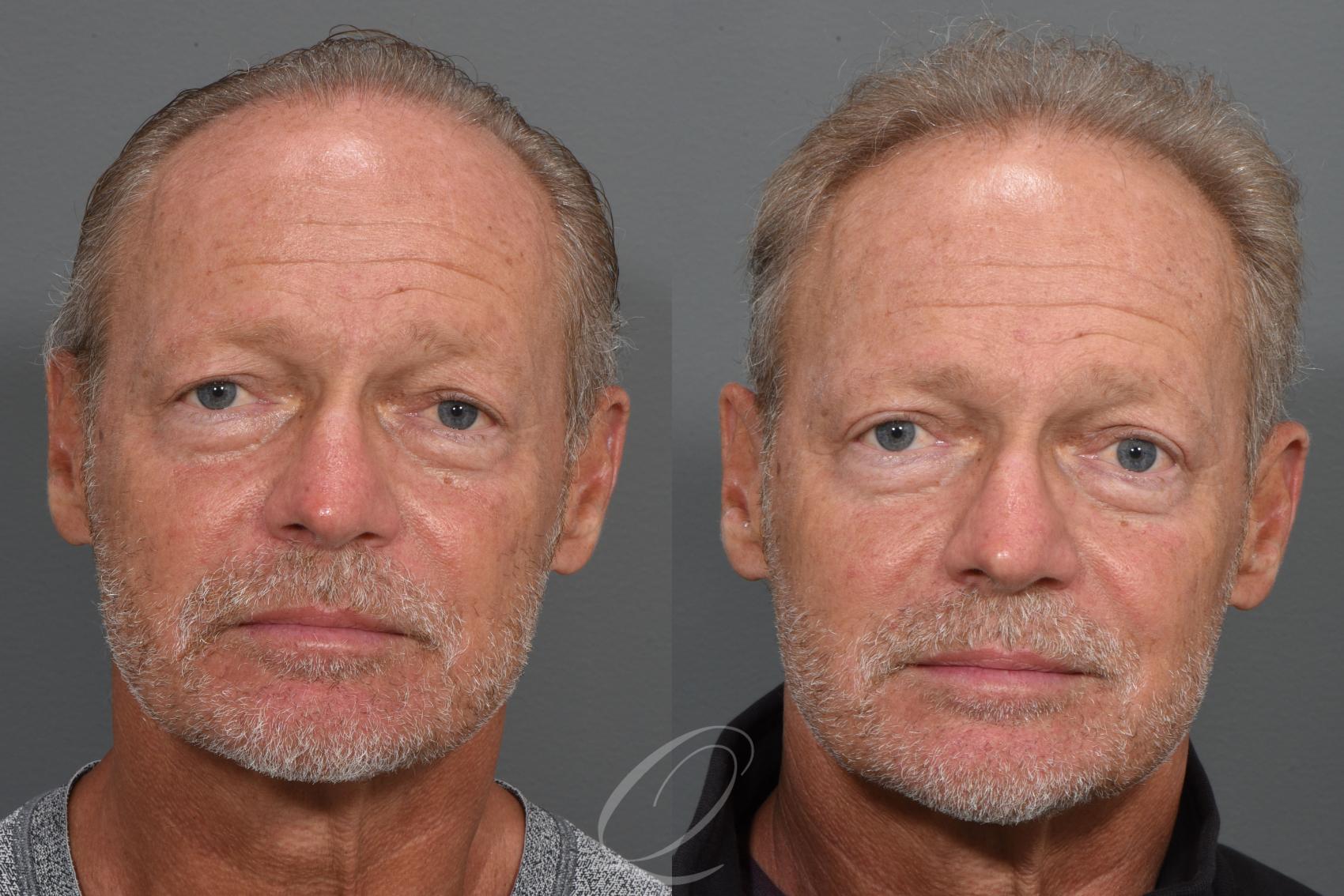 Eyelid Lift Case 1404 Before & After Front | Serving Rochester, Syracuse & Buffalo, NY | Quatela Center for Plastic Surgery